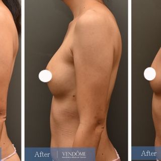 療程效果因人而異，上圖為A罩杯產後女性在做完自體脂肪隆乳之後​手術後一個月、手術後五個月成效